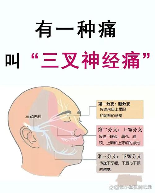 三叉神经痛的症状诊断